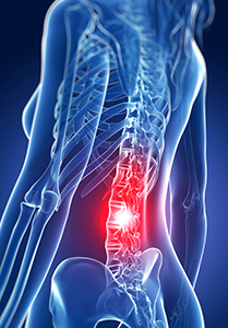 Radiation Therapy for Metastatic Spinal Tumors