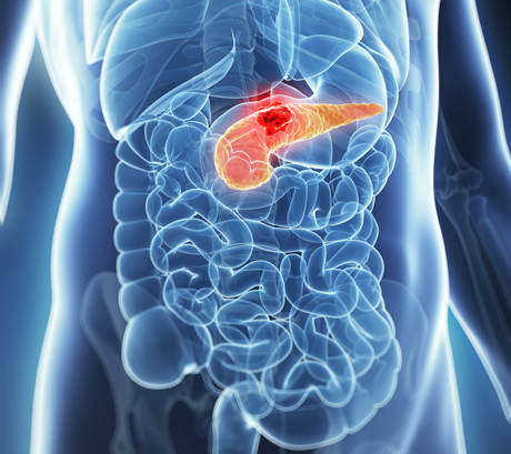 Emerging Role of Stereotactic Body Radiotherapy in the Treatment of Pancreatic Cancer