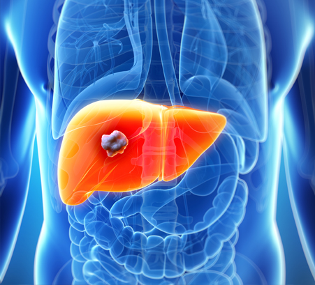 liver-cancer