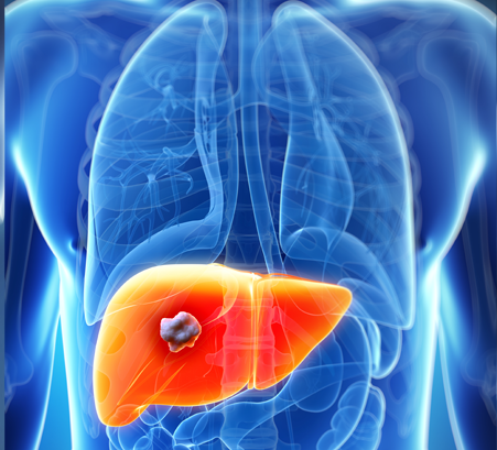 Radiation for liver cancer: How it works, side effects, success rate