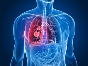 symptoms of lung cancer